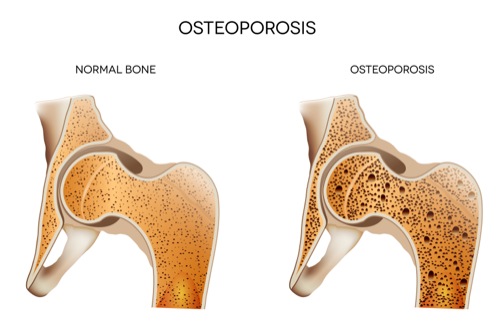 Bone Mineral Density